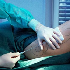 Cosmetic Procedures and Liposuction