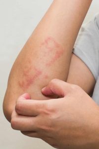 Sweat Rash Treatment