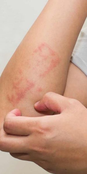 Sweat Rash Treatment