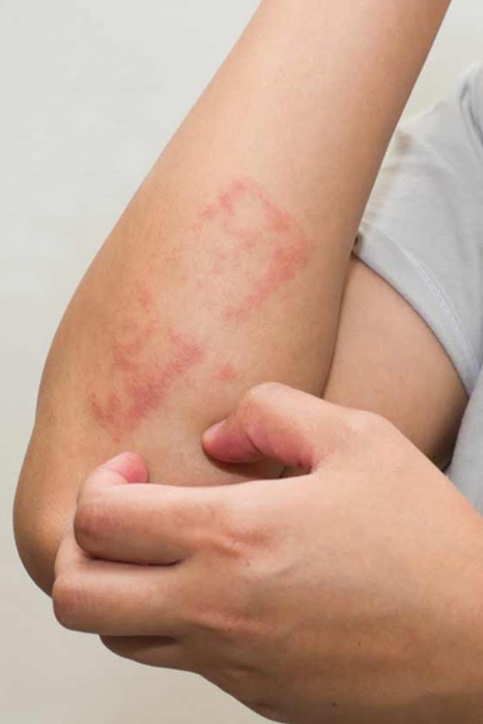 Sweat Rash Treatment