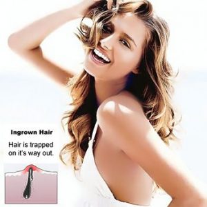 How To Prevent Ingrown Hairs After Epilation