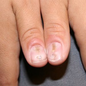Nails abnormalities & their causes!