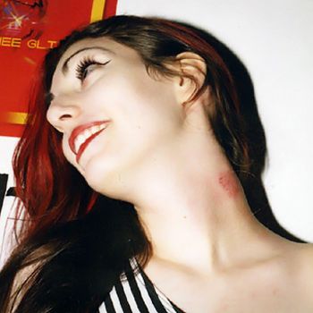 Remove Love bite bruises instantly!