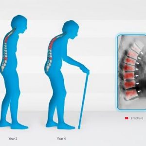 Special Report: Osteoporosis