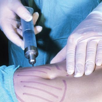 Lose a Fat Cell, Get a Fat Cell: Is Liposuction Worth It?