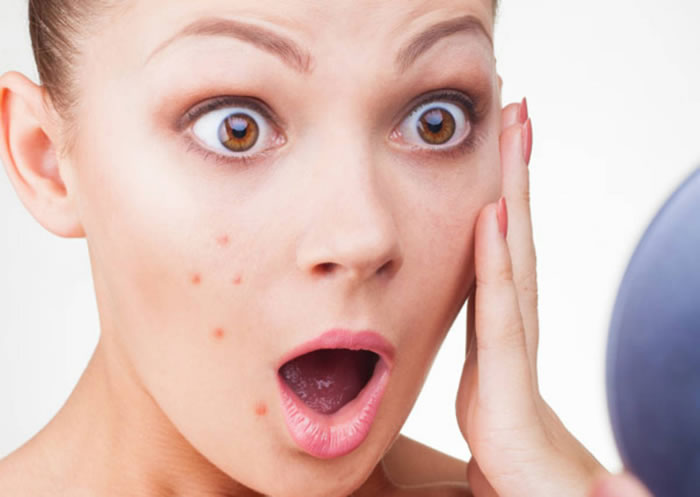 Works on Acne and Pimples