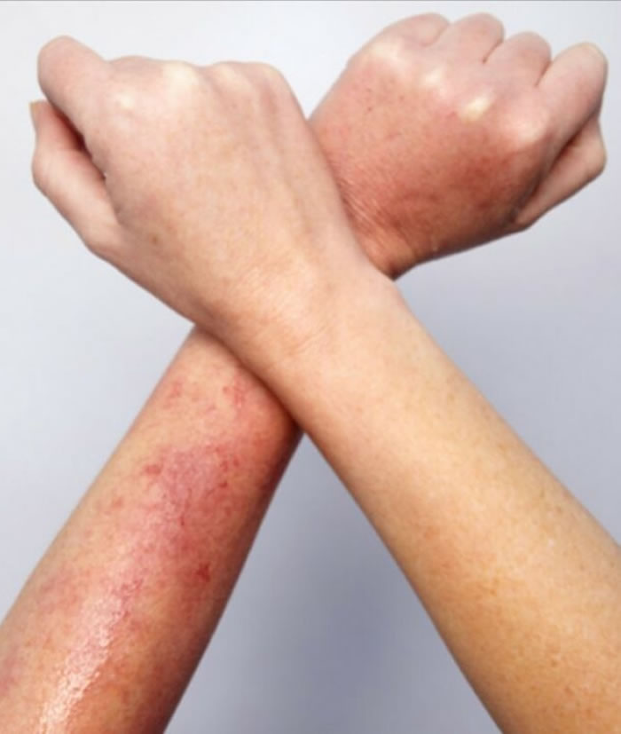 Heat rash skin