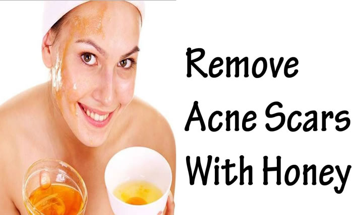 Honey for an effective acne treatment