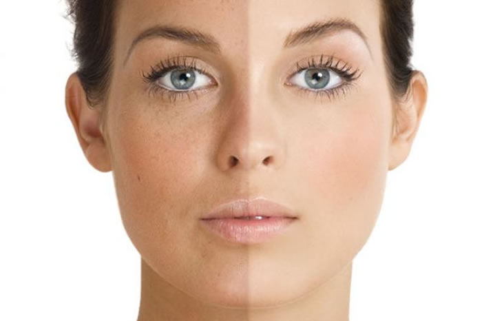 Pigmentation For women