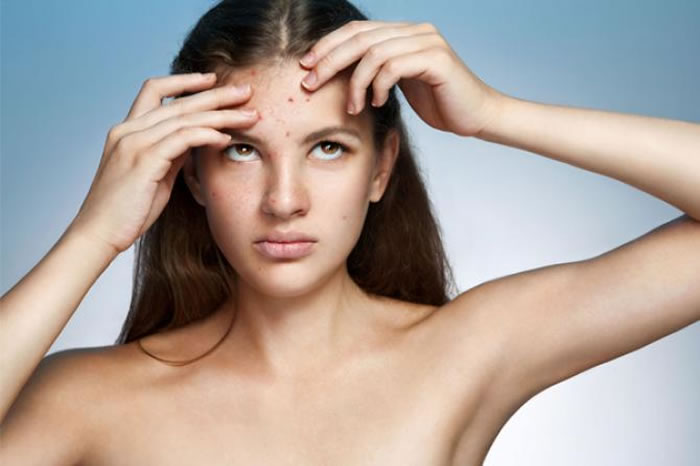 The Real Reasons Behind Acne In These 7 Spots Will Surprise You