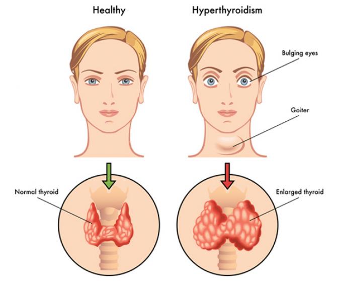 Thyroid Symptoms, Causes And Effective Home Remedies