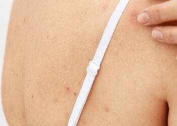 10 Ways To Treat Pimples on the Back
