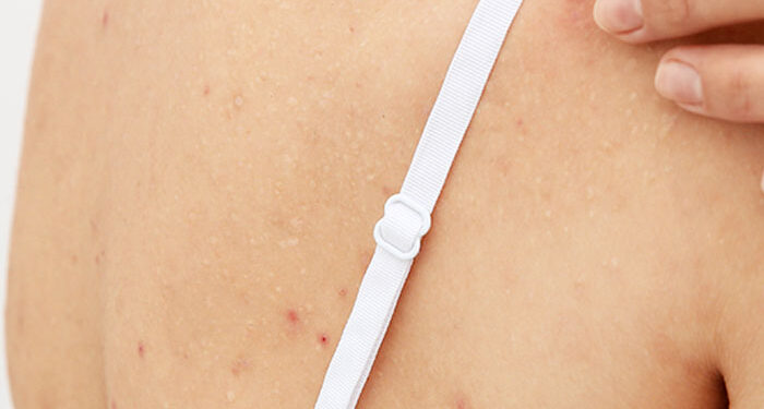10 Ways To Treat Pimples on the Back