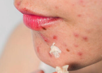10 Home Remedies For Acne That Work Fast