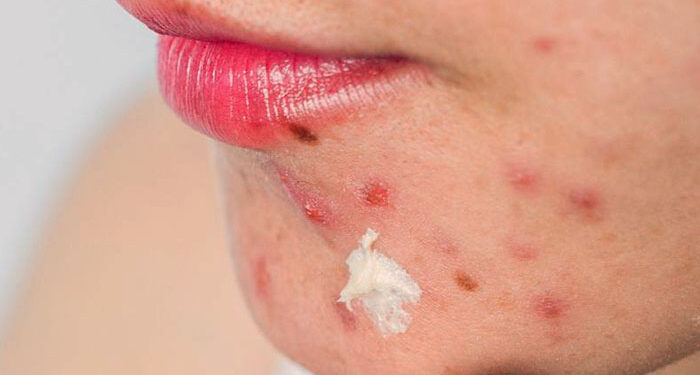 10 Home Remedies For Acne That Work Fast