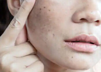 10 Face Packs to Clear Dark Spots