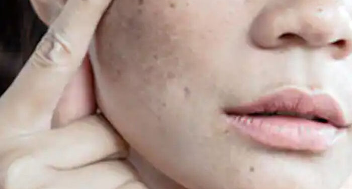 10 Face Packs to Clear Dark Spots