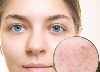 Home Remedies To Remove Dark Spots Caused by Pimples