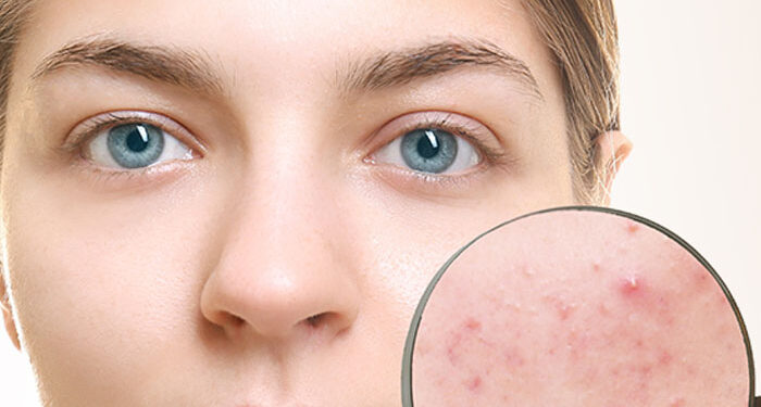 Home Remedies To Remove Dark Spots Caused by Pimples
