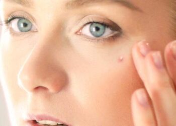 12 Ways To Get Rid of Whiteheads