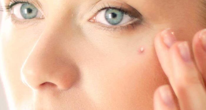 12 Ways To Get Rid of Whiteheads