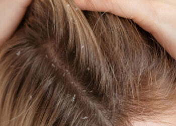 How To Get Beautiful Dandruff Free Hair In Just 4 Weeks
