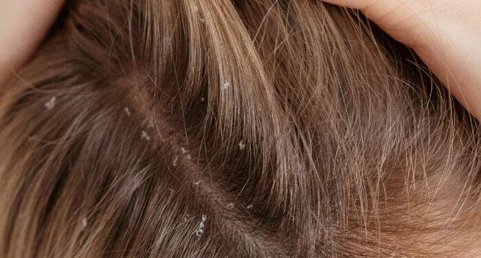 How To Get Beautiful Dandruff Free Hair In Just 4 Weeks