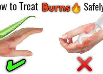 What Types Of Burns Cause Scars?