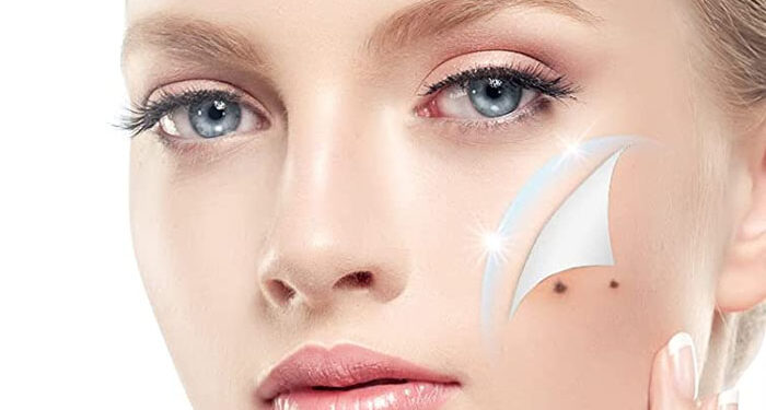 Why You Should Think Twice Before Removing a Skin Tag At Home