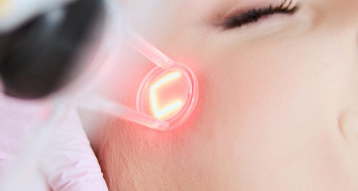 5 Reasons Why You Should Opt For Laser Skin Rejuvenation